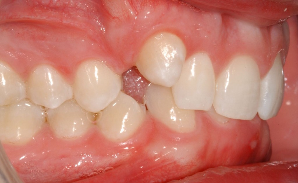 teeth braces before and after. Canine tooth doesn#39;t want to