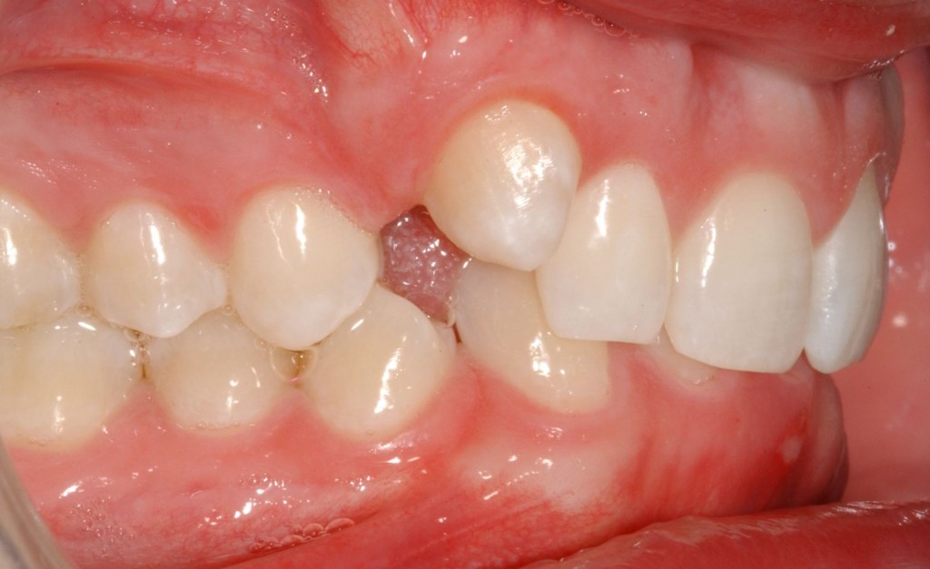 teeth braces before and after. Canine tooth doesn#39;t want to