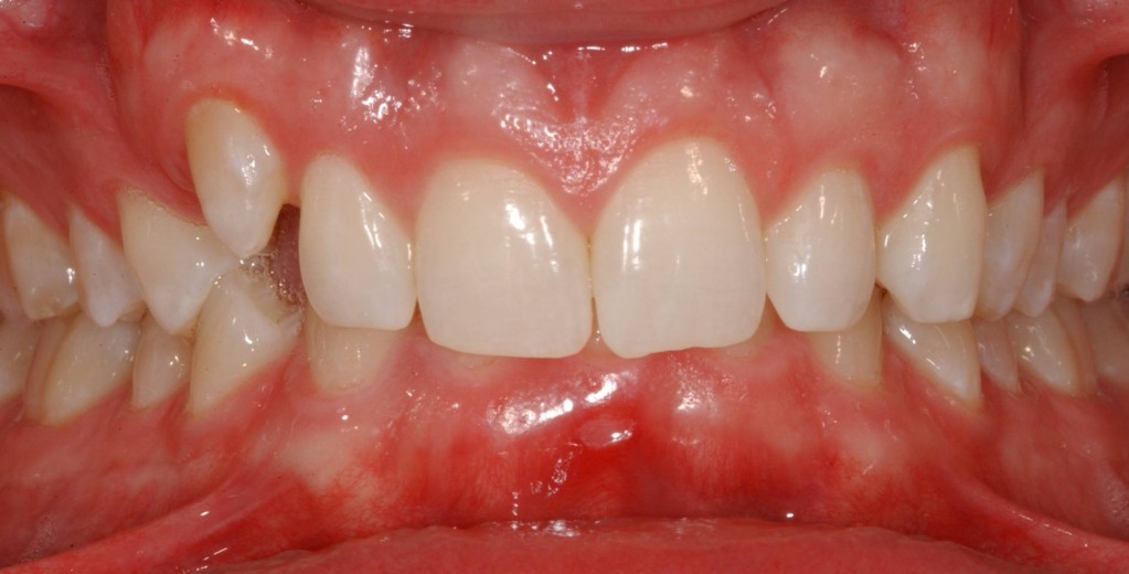 Notice the Upper Right Tooth that is Higher than the other teeth and that the lower teeth are completely covered.