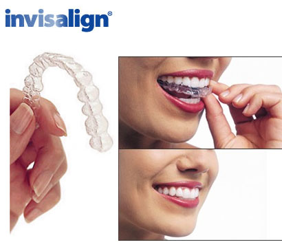 Best Invisalign Treatment  Lawrenceville, Loganville, Morrow