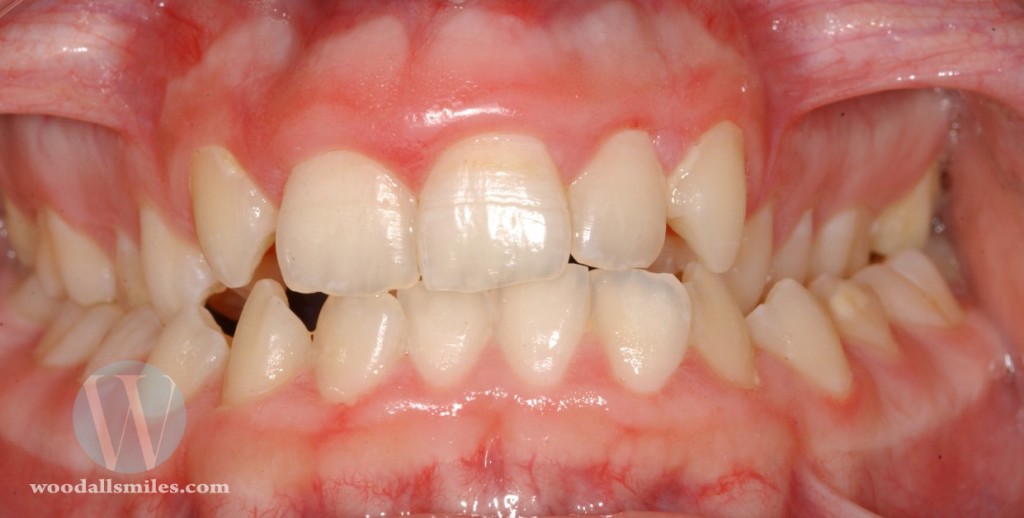 This Is an Example of a Cross Bite- Notice how the upper jaw is narrow and the upper teeth sit inside the lower teeth.