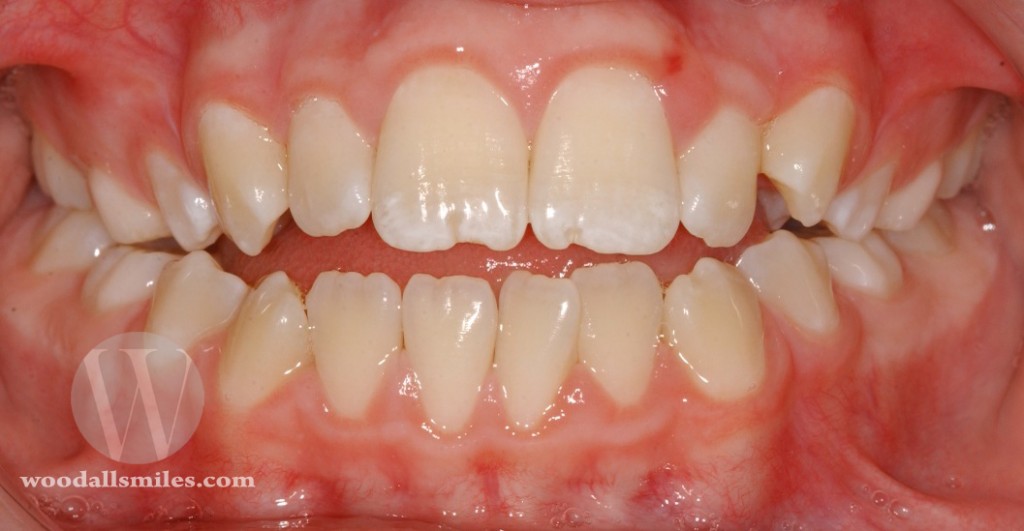 Example of an Openbite- Notice the back teeth touch but the front teeth do not overlap at all.