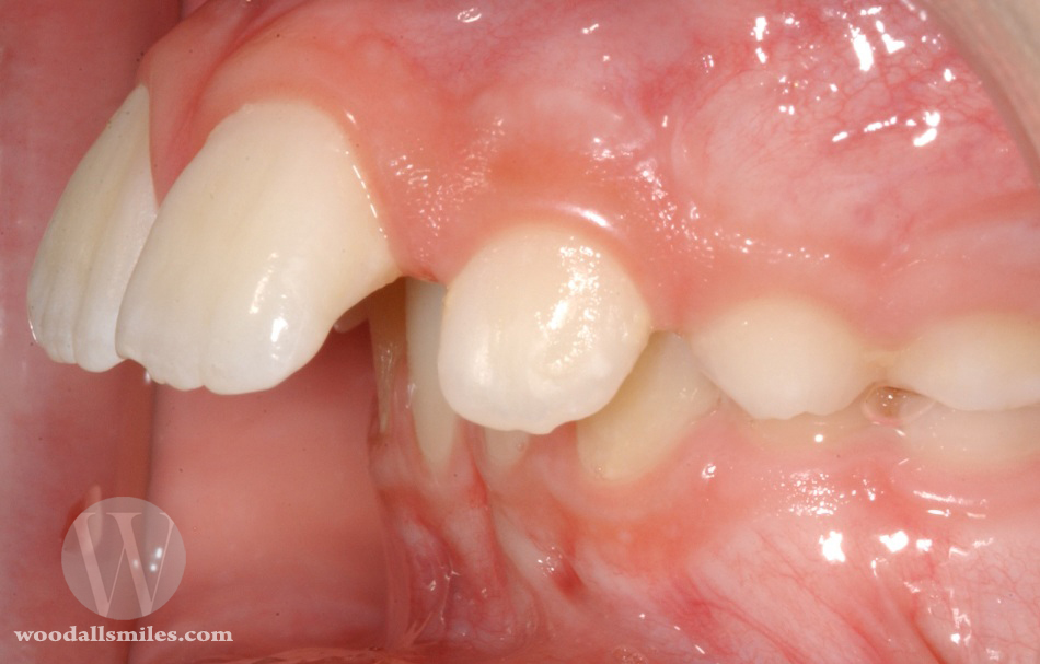 Protruding Buck Teeth Orthodontist Pacifier Thumb This patient had protruding upper front permanent teeth from a thumb habit- Patient was 7 years old.